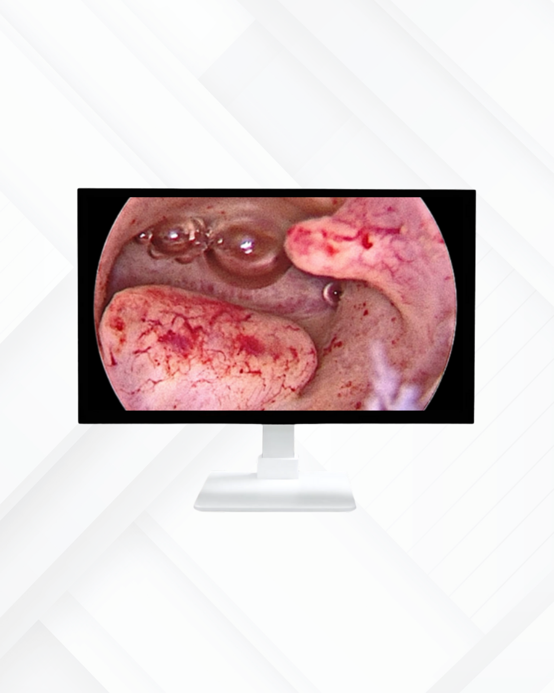 FHD Endoscopy Endoscopy